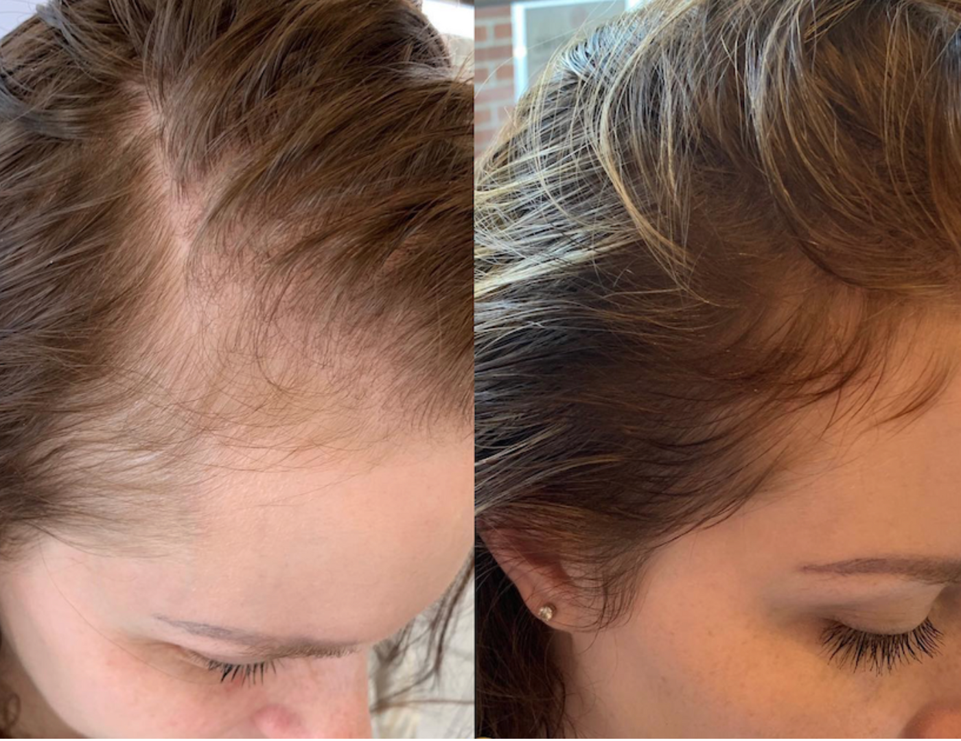 revol-signature-saint-cyprien-66-soins-acne-anti-ride-sans-aiguille-colorimétrie-radiofrequence-led