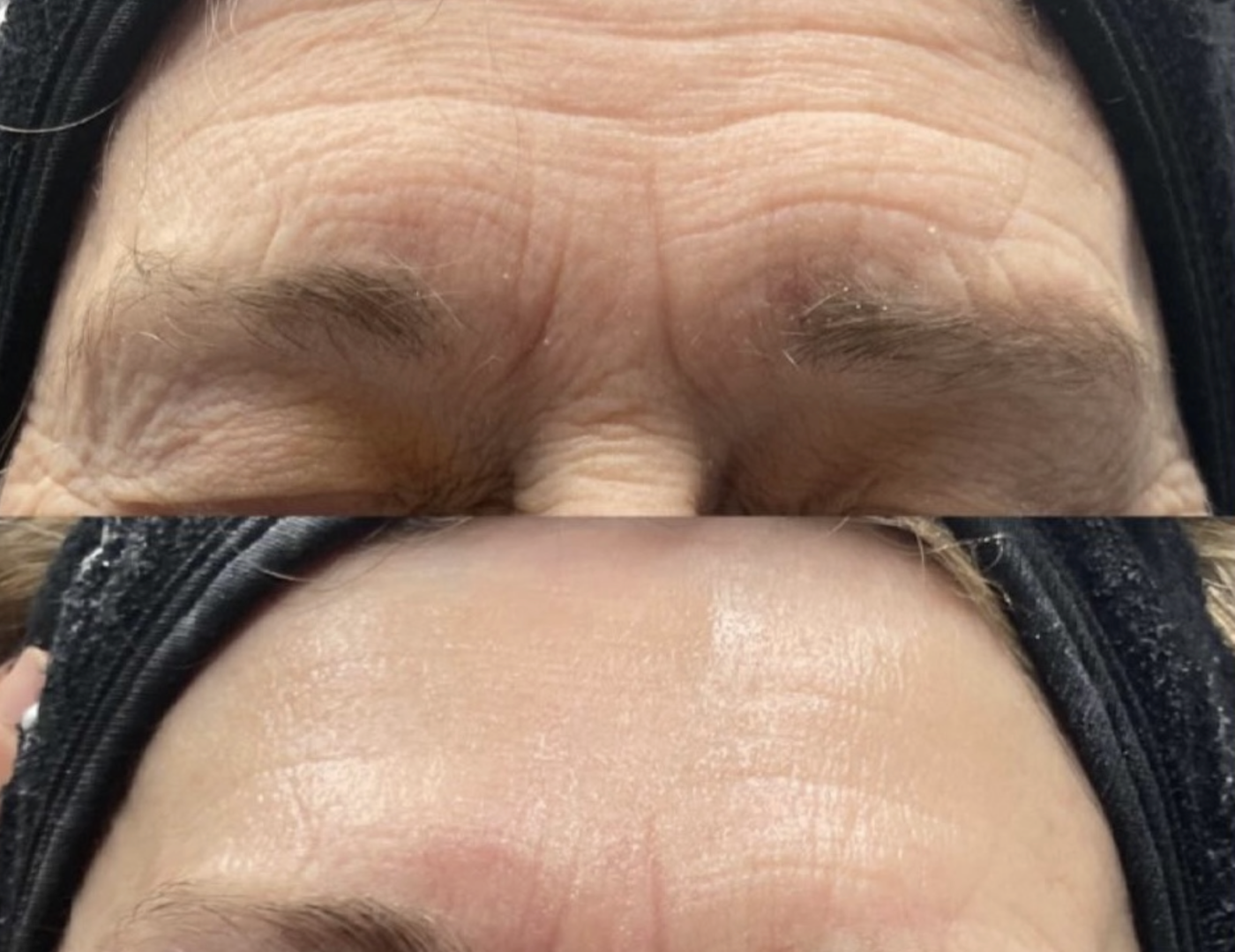 revol-signature-saint-cyprien-66-soins-acne-anti-ride-sans-aiguille-colorimétrie-radiofrequence-led