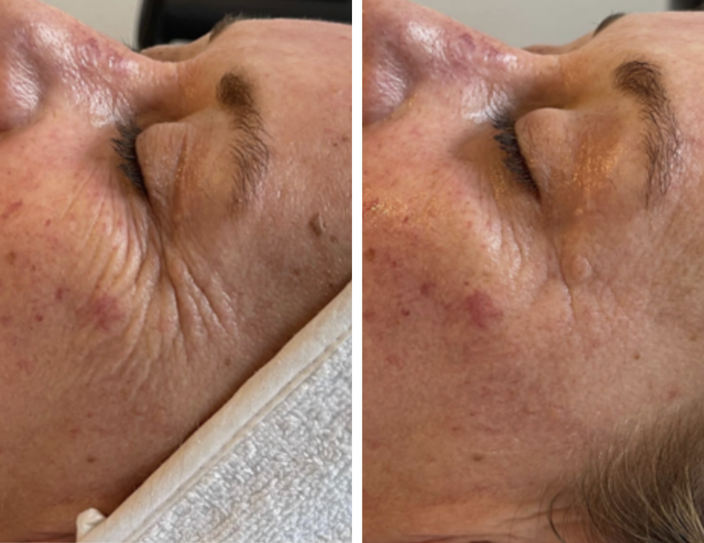 revol-signature-saint-cyprien-66-soins-acne-anti-ride-sans-aiguille-colorimétrie-radiofrequence-led