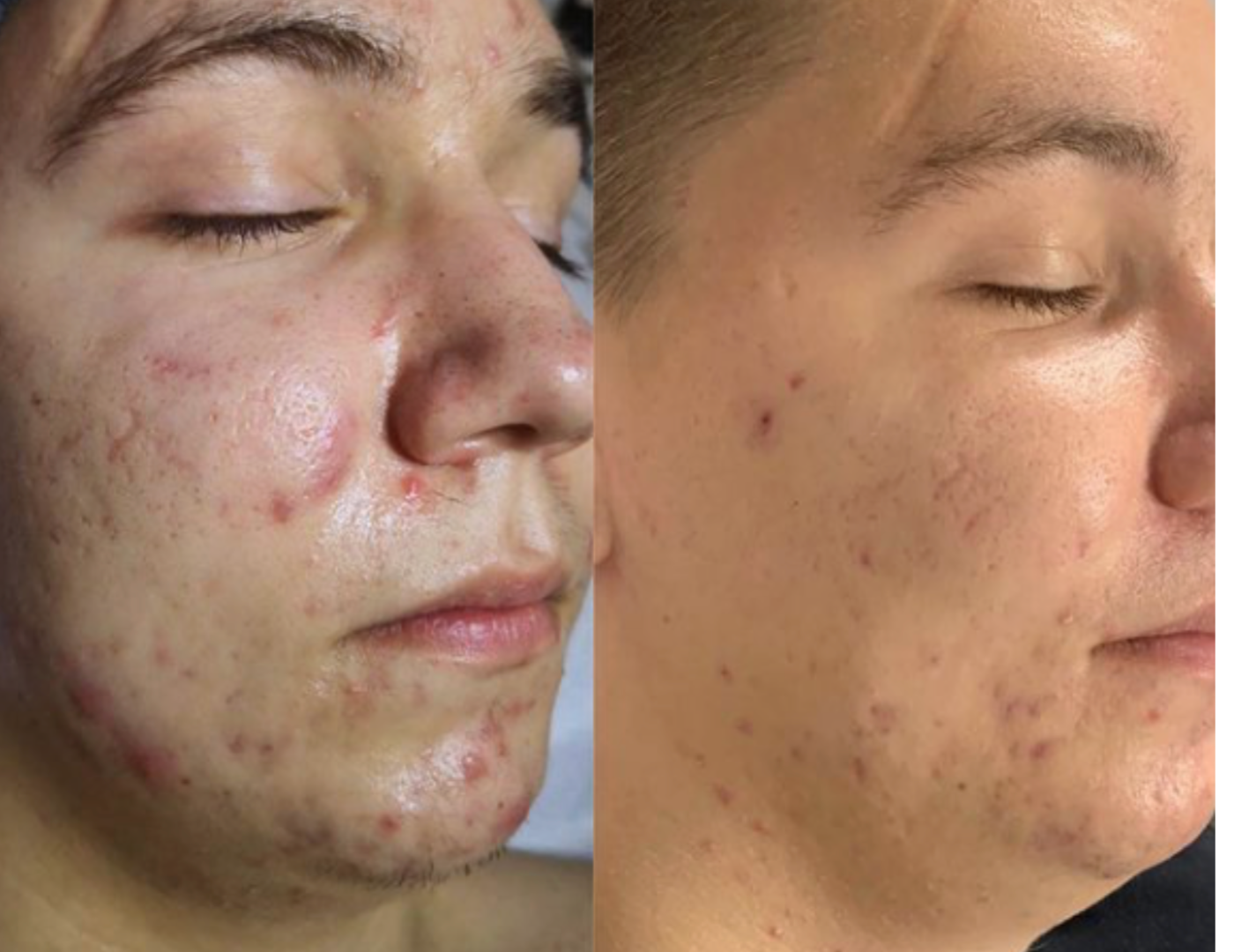 revol-signature-saint-cyprien-66-soins-acne-anti-ride-sans-aiguille-colorimétrie-radiofrequence-led